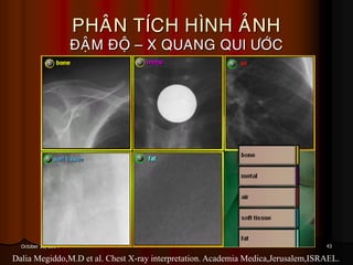 43October 31, 2014
PHAÂN TÍCH HÌNH AÛNH
ÑAÄM ÑOÄ – X QUANG QUI ÖÔÙC
Dalia Megiddo,M.D et al. Chest X-ray interpretation. Academia Medica,Jerusalem,ISRAEL.
 