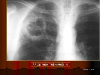 October 31, 2014
AÙP-XE THUØY TREÂN PHOÅI (P)
 