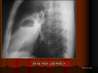 October 31, 2014
AÙP-XE THUØY LÖÔÕI PHOÅI (T)
 