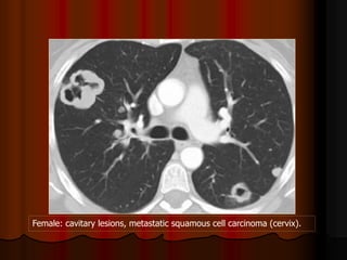 Female: cavitary lesions, metastatic squamous cell carcinoma (cervix).
 