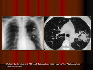 Mukesh G. Harisinghani, MD et al. Tuberculosis from Head to Toe. Radiographics.
2000;20:449-470.
 