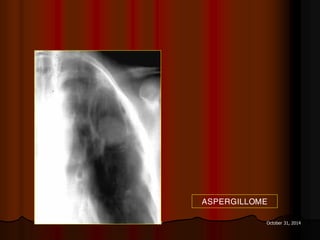 77 October 31, 2014
ASPERGILLOME
 