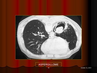 78 October 31, 2014
ASPERGILLOME
 