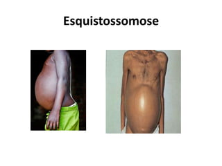 Esquistossomose
 