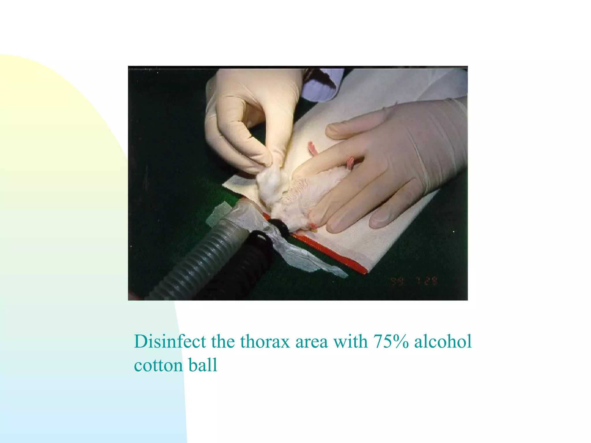 Disinfect the thorax area with 75% alcohol
cotton ball
 