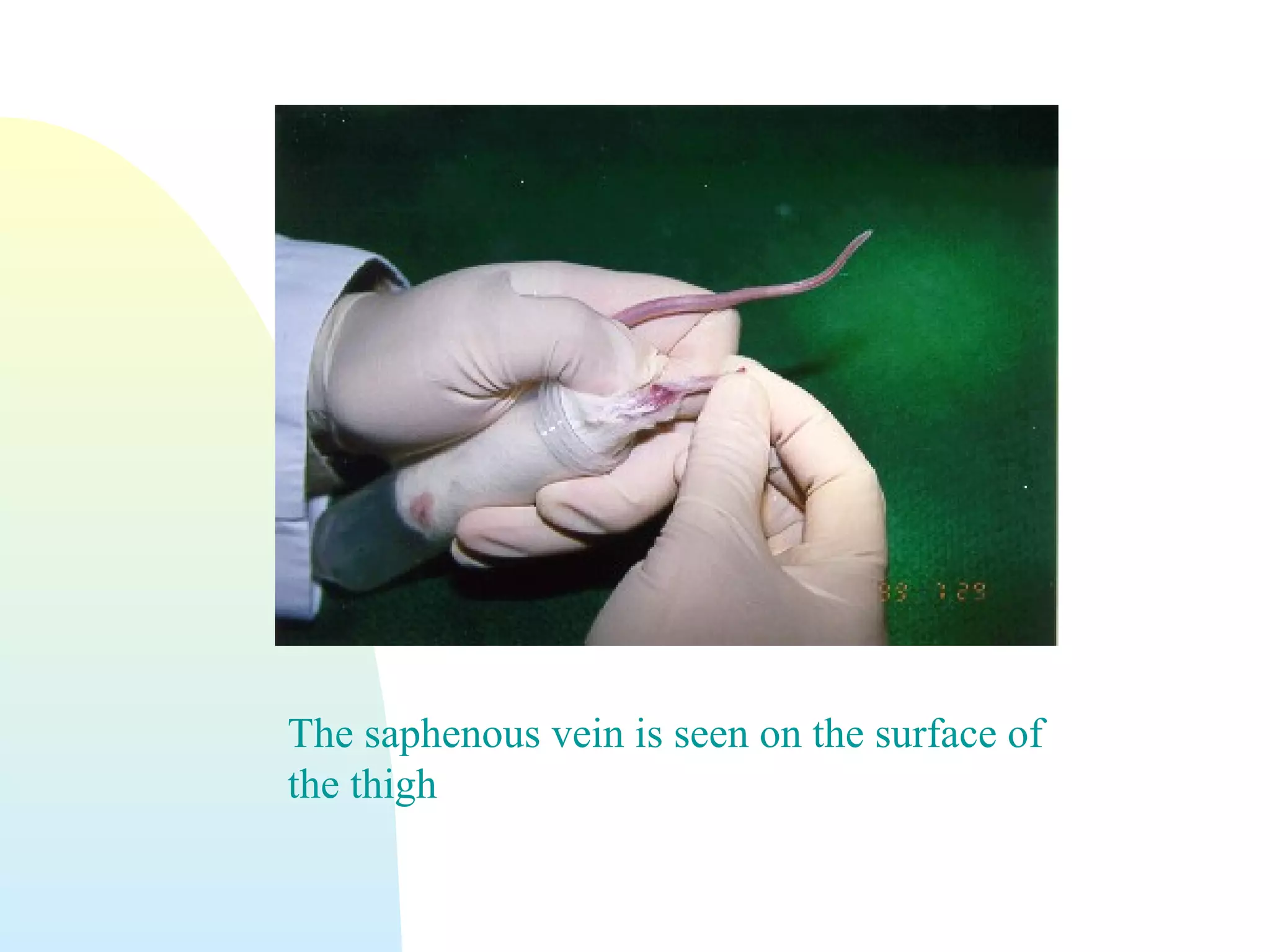 The saphenous vein is seen on the surface of
the thigh
 
