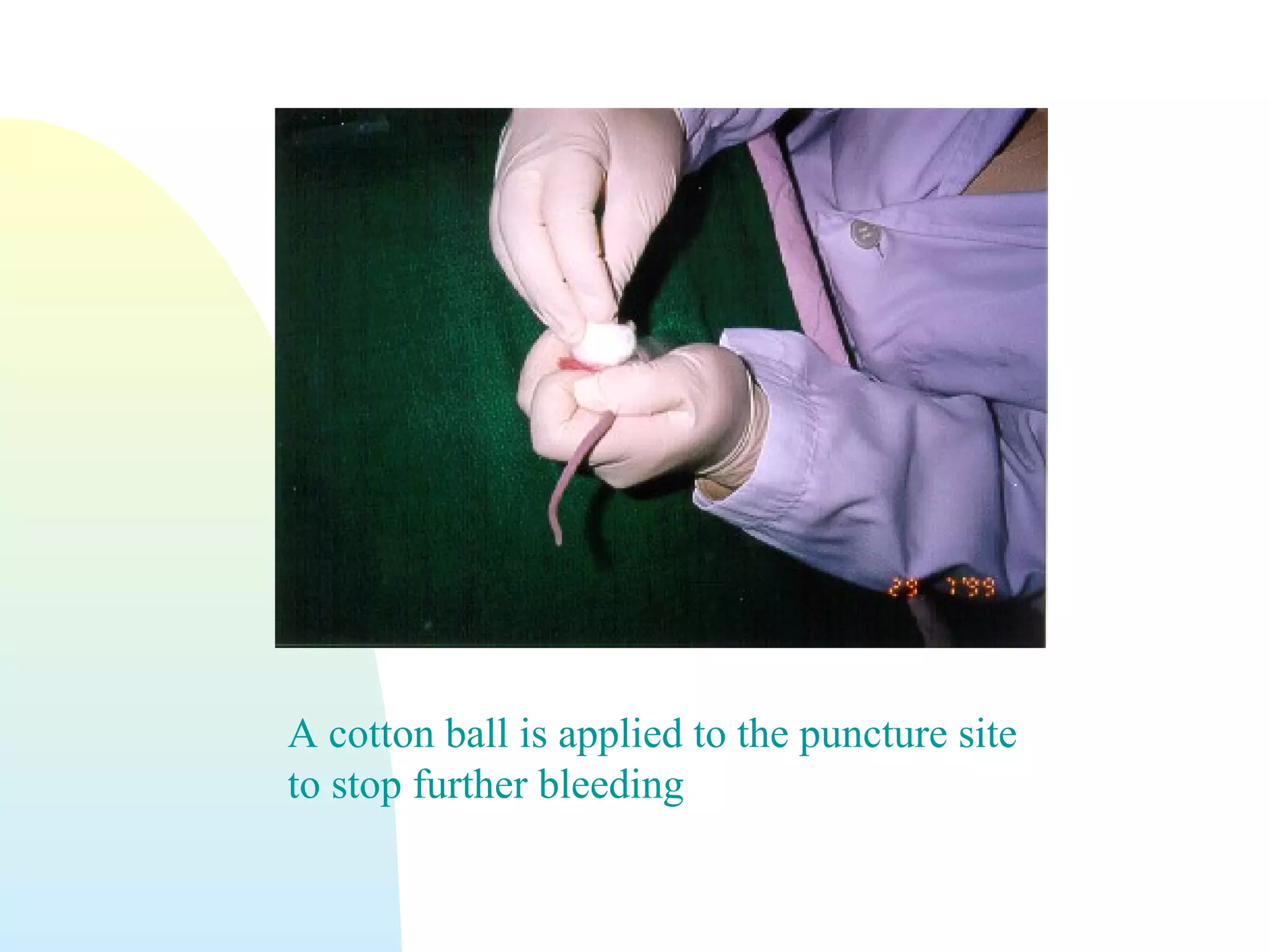 A cotton ball is applied to the puncture site
to stop further bleeding
 