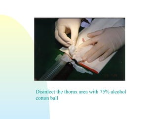 Disinfect the thorax area with 75% alcohol
cotton ball
 