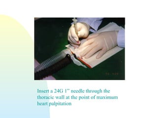 Insert a 24G 1” needle through the
thoracic wall at the point of maximum
heart palpitation
 