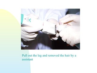 Pull out the leg and removed the hair by a
assistant
 