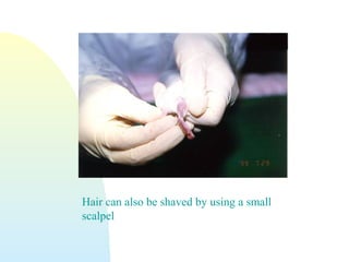Hair can also be shaved by using a small
scalpel
 