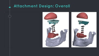 Attachment Design: Overall
 