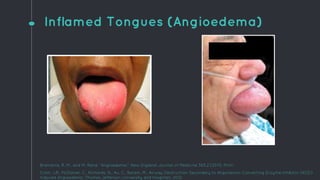 Inflamed Tongues (Angioedema)
Bramante, R. M., and M. Rand. "Angioedema." New England Journal of Medicine 365.2 (2011). Print.
Cohn, J.R., McDaniel, C., Richards, N., Au, C., Baram, M., Airway Obstruction Secondary to Angiotensin Converting Enzyme Inhibitor (ACEI)
Induced Angioedema. Thomas Jefferson University and Hospitals, 2012.
 