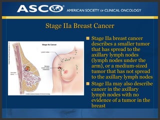 Stage IIa Breast CancerStage IIa Breast Cancer
Stage IIa breast cancerStage IIa breast cancer
describes a smaller tumordes...
