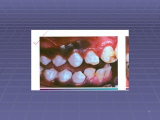 Inconistent Teeth Comprehensive Overview of Tooth Abnormalities and Their Clinical ...