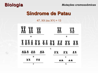 BiologiaBiologia Mutações cromossômicas
Síndrome de PatauSíndrome de Patau
47, XX (ou XY) + 13
 