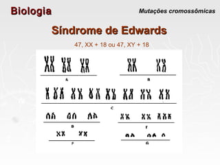 BiologiaBiologia Mutações cromossômicas
Síndrome de EdwardsSíndrome de Edwards
47, XX + 18 ou 47, XY + 18
 
