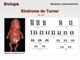BiologiaBiologia Mutações cromossômicas
Síndrome de TurnerSíndrome de Turner
45, X0
Natimorto - Síndrome de Turner
 