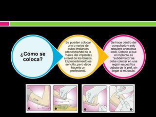 Se hace dentro del
consultorio y solo
requiere anestesia
local. Debido a que
el implante es
“subdérmico” se
debe colocar en una
región específica
debajo de la piel, sin
llegar al músculo.
Se pueden colocar
uno o varios de
estos implantes
(dependiendo de la
marca del implante)
a nivel de los brazos.
El procedimiento es
sencillo, pero debe
hacerlo un
profesional.
¿Cómo se
coloca?
 