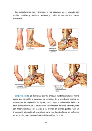 12
Las articulaciones más vulnerables a los esguinces en el deporte son
tobillos, rodillas y hombros. Muñecas y codos se afectan con menor
frecuencia.
Sinovitis aguda. La membrana sinovial articular puede lesionarse de forma
aguda por contusión o esguince. La irritación de la membrana origina un
aumento en la producción de líquido, dando lugar a inflamación. Debido a
esto, el movimiento de la articulación se acompaña de dolor articular junto
con hipersensibilidad de la piel a la presión en ciertos puntos. Con un
tratamiento adecuado, el acumulo de sangre en la articulación se reabsorbe
en pocos días, con disminución de la inflamación y del dolor.
 