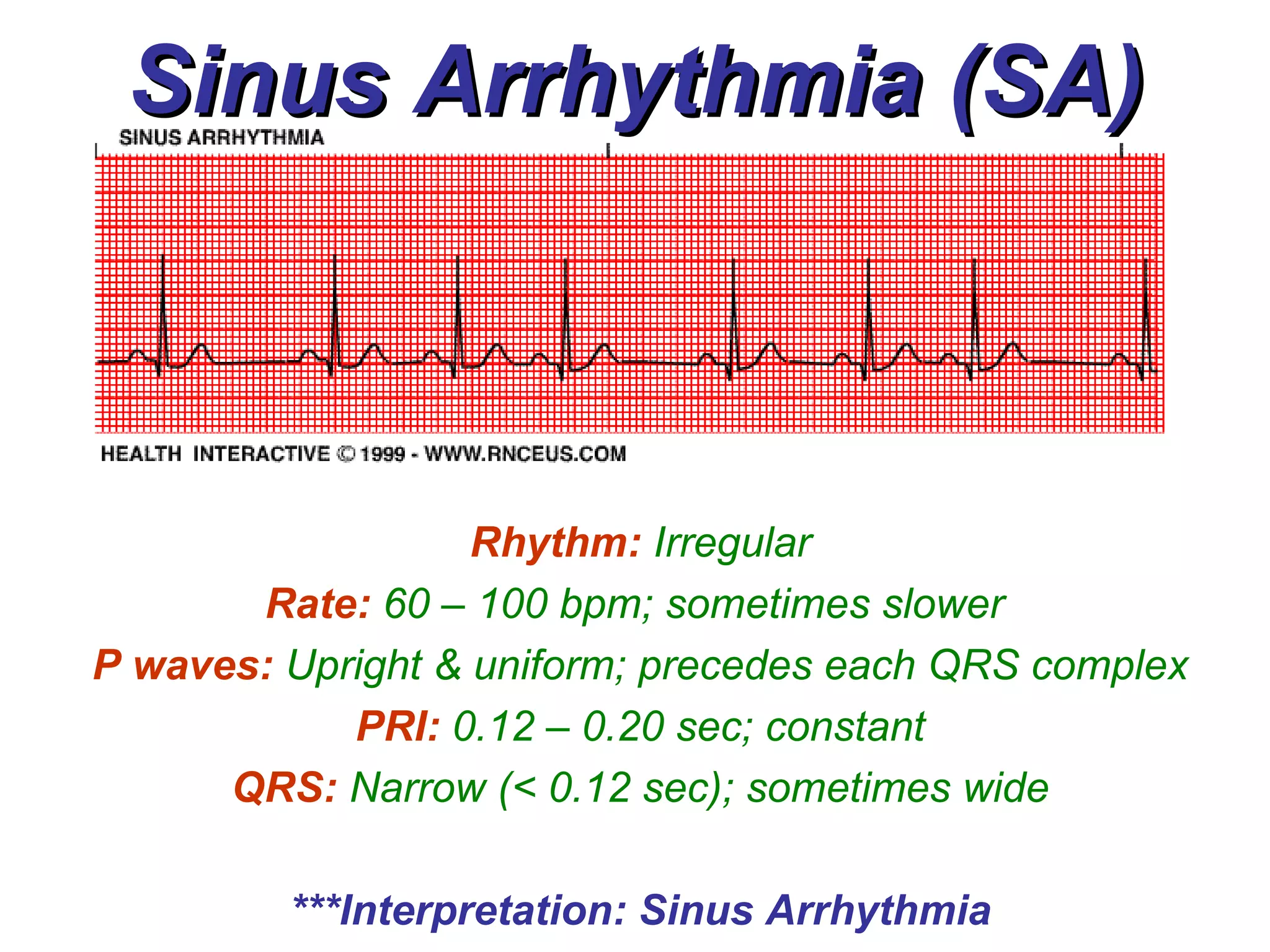Sinus Arrhythmia (SA) Rhythm:   Irregular Rate:   60 – 100 bpm; sometimes slower   P waves:   Upright & uniform; precedes each QRS complex PRI:   0.12 – 0.20 sec; constant QRS:   Narrow (< 0.12 sec); sometimes wide ***Interpretation: Sinus Arrhythmia 