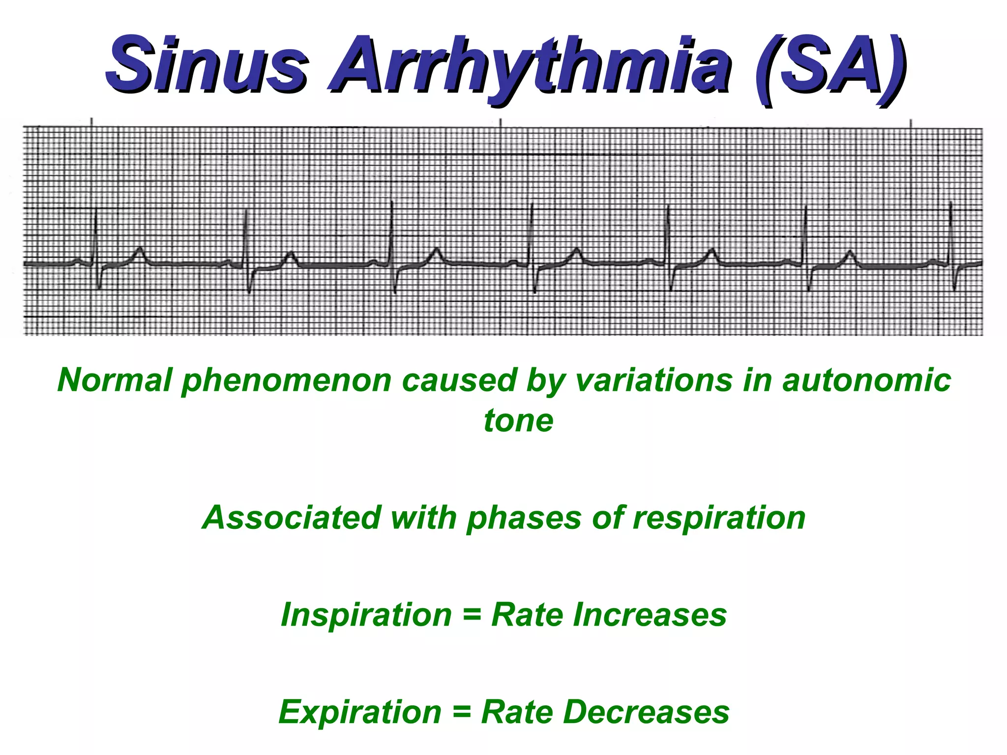 Sinus Arrhythmia (SA) Normal phenomenon caused by variations in autonomic tone  Associated with phases of respiration Inspiration = Rate Increases Expiration = Rate Decreases 