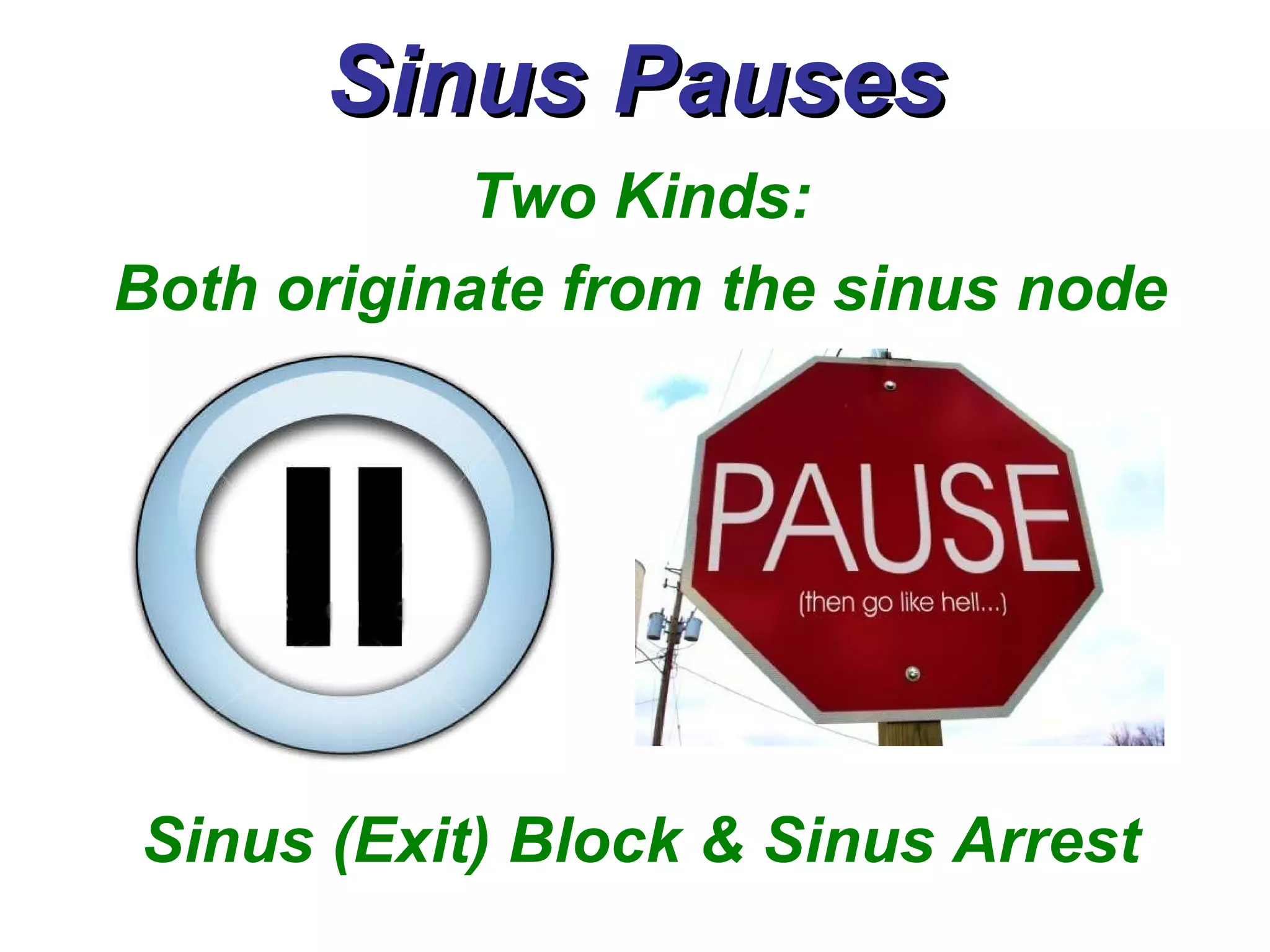 Sinus Pauses Two Kinds: Both originate from the sinus node Sinus (Exit) Block & Sinus Arrest 