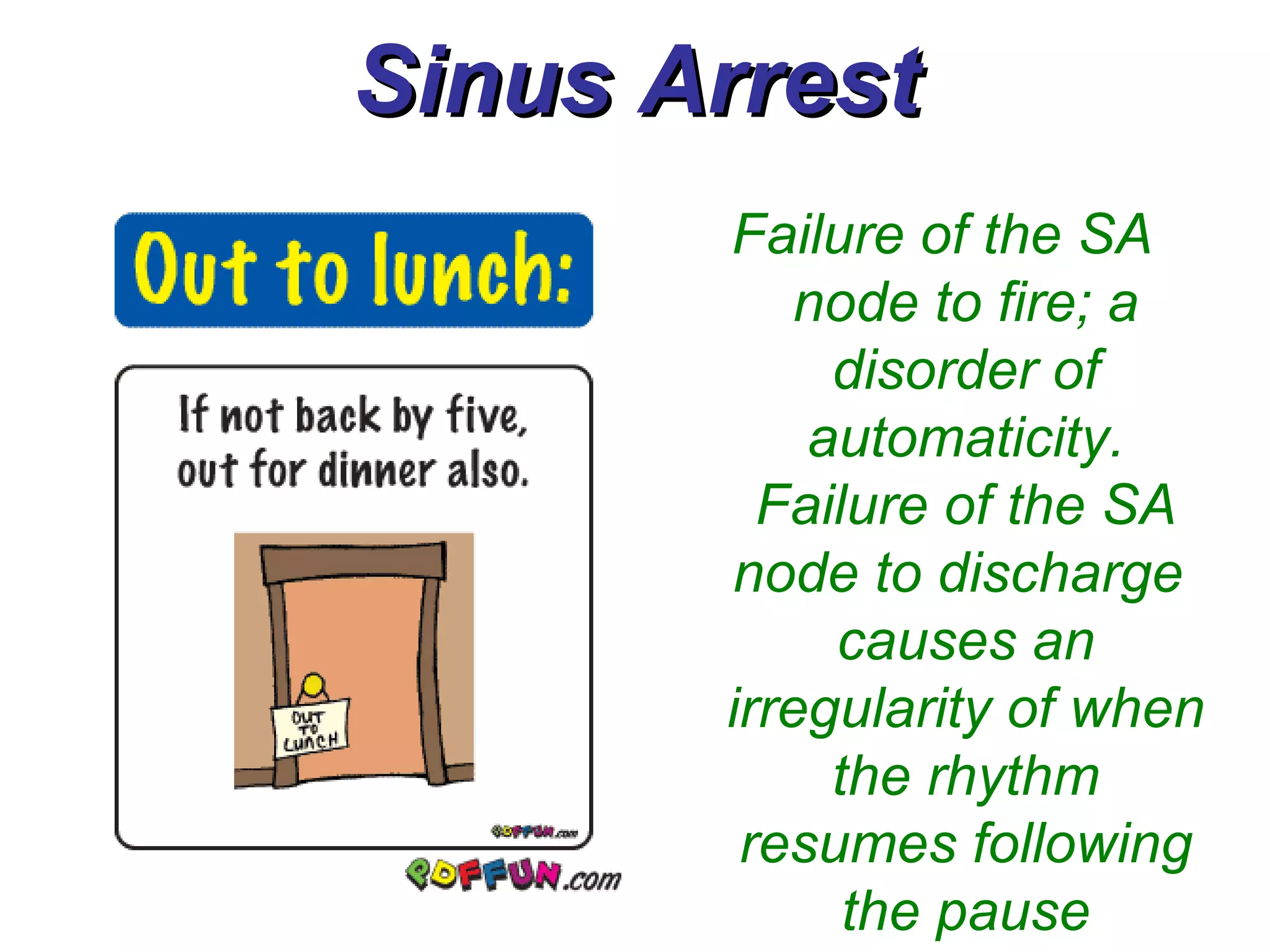 Sinus Arrest Failure of the SA node to fire; a disorder of automaticity. Failure of the SA node to discharge  causes an irregularity of when the rhythm resumes following the pause 