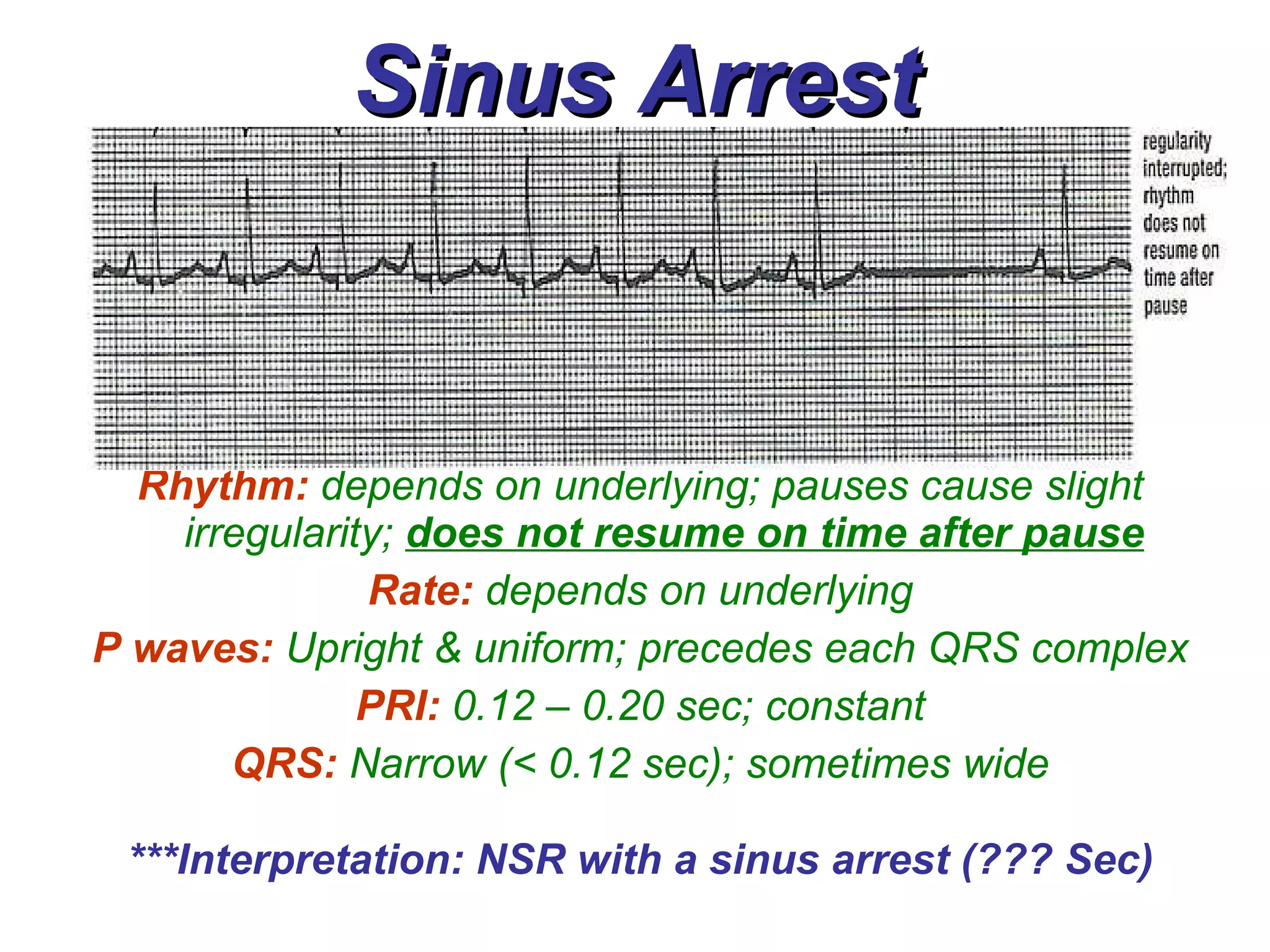 Sinus Arrest Rhythm:   depends on underlying; pauses cause slight irregularity;  does not   resume on time after pause Rate:   depends on underlying P waves:   Upright & uniform; precedes each QRS complex PRI:   0.12 – 0.20 sec; constant QRS:   Narrow (< 0.12 sec); sometimes wide ***Interpretation: NSR with a sinus arrest (??? Sec) 