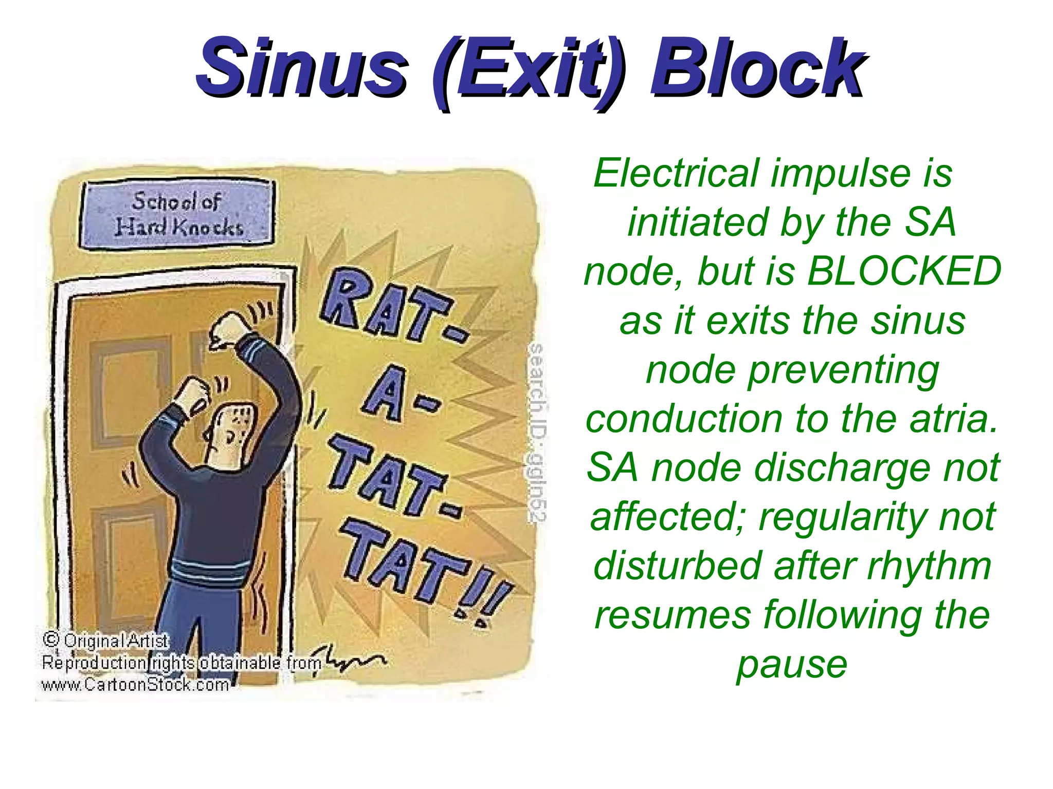 Sinus (Exit) Block Electrical impulse is initiated by the SA node, but is BLOCKED as it exits the sinus node preventing conduction to the atria. SA node discharge not affected; regularity not disturbed after rhythm resumes following the pause                        