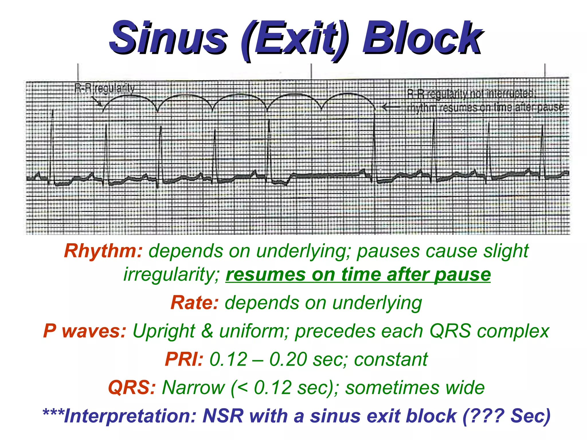 Sinus (Exit) Block Rhythm:   depends on underlying; pauses cause slight irregularity;  resumes on time after pause Rate:   depends on underlying P waves:   Upright & uniform; precedes each QRS complex PRI:   0.12 – 0.20 sec; constant QRS:   Narrow (< 0.12 sec); sometimes wide ***Interpretation: NSR with a sinus exit block (??? Sec) 