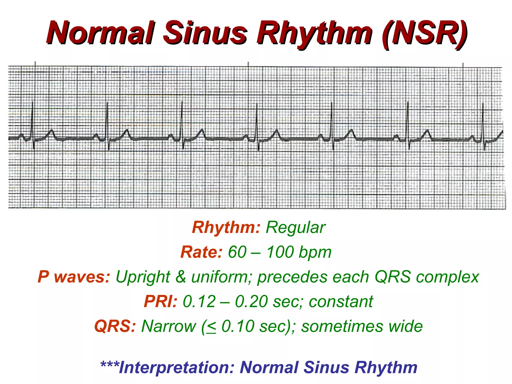 Normal Sinus Rhythm (NSR) Rhythm:   Regular Rate:   60 – 100 bpm  P waves:   Upright & uniform; precedes each QRS complex PRI:   0.12 – 0.20 sec; constant QRS:   Narrow ( <  0.10 sec); sometimes wide ***Interpretation: Normal Sinus Rhythm 
