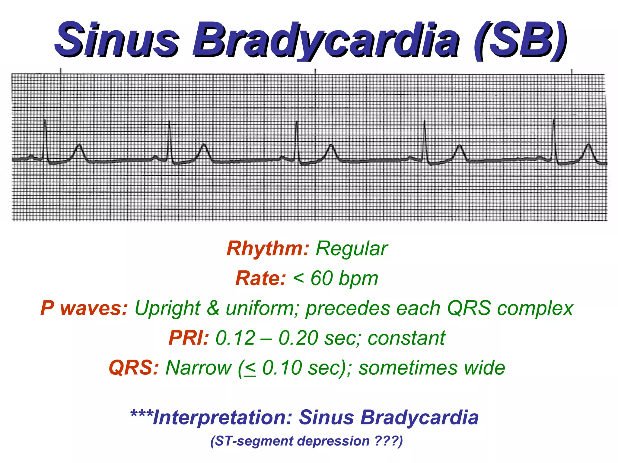 Sinus Bradycardia (SB) Rhythm:   Regular Rate:  < 60 bpm P waves:   Upright & uniform; precedes each QRS complex PRI:   0.12 – 0.20 sec; constant QRS:   Narrow ( <  0.10 sec); sometimes wide ***Interpretation: Sinus Bradycardia  (ST-segment depression ???) 