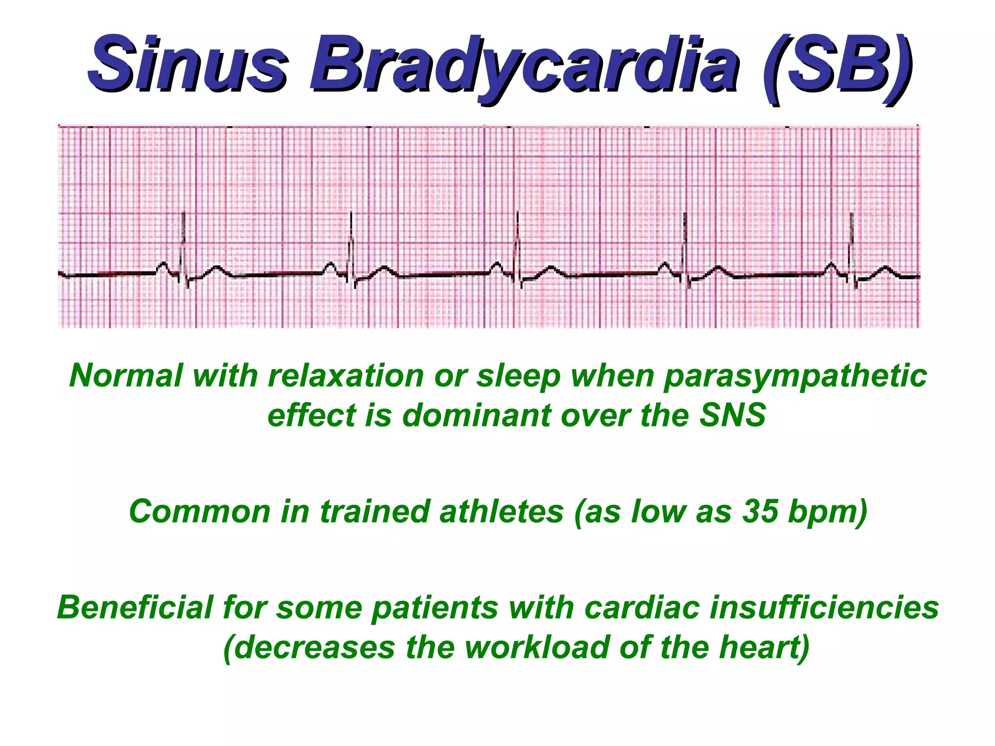 Sinus Bradycardia (SB) Normal with relaxation or sleep when parasympathetic effect is dominant over the SNS Common in trained athletes (as low as 35 bpm) Beneficial for some patients with cardiac insufficiencies (decreases the workload of the heart) 