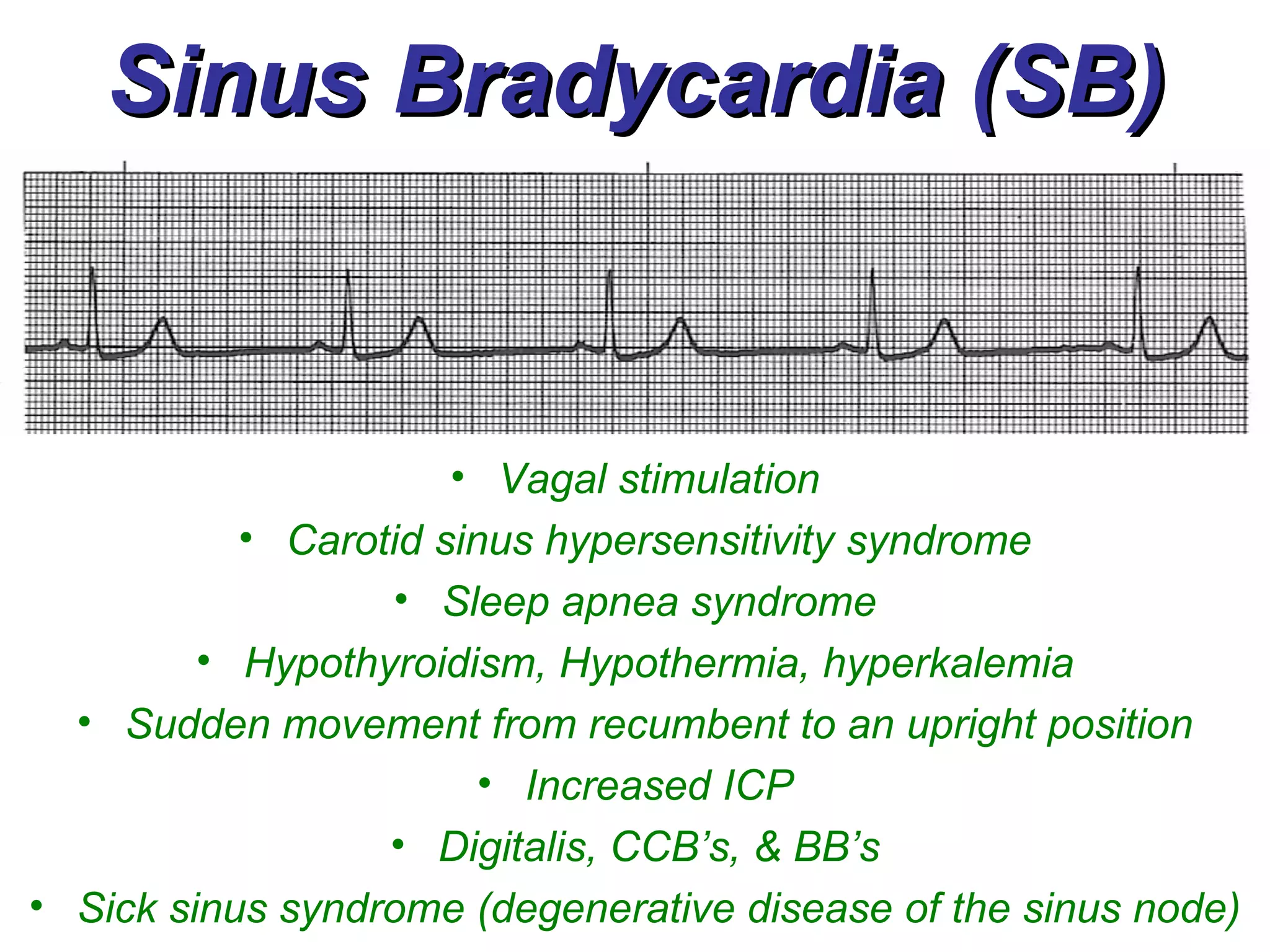 Sinus Bradycardia (SB) Vagal stimulation Carotid sinus hypersensitivity syndrome Sleep apnea syndrome Hypothyroidism, Hypothermia, hyperkalemia Sudden movement from recumbent to an upright position Increased ICP Digitalis, CCB’s, & BB’s Sick sinus syndrome (degenerative disease of the sinus node) 