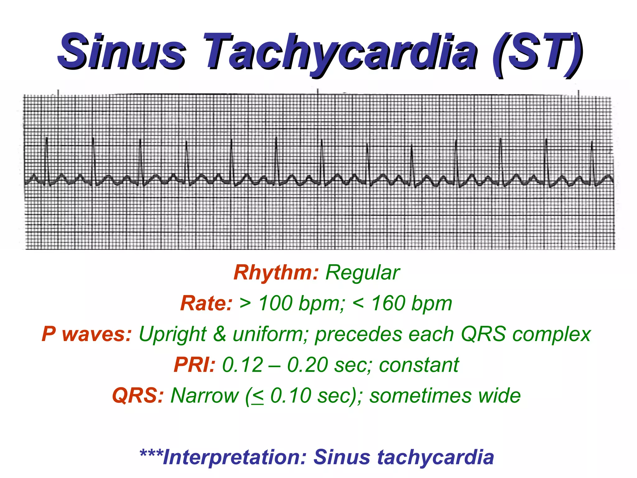 Sinus Tachycardia (ST) Rhythm:   Regular Rate:   > 100 bpm; < 160 bpm P waves:   Upright & uniform; precedes each QRS complex PRI:   0.12 – 0.20 sec; constant QRS:   Narrow ( <  0.10 sec); sometimes wide ***Interpretation: Sinus tachycardia 