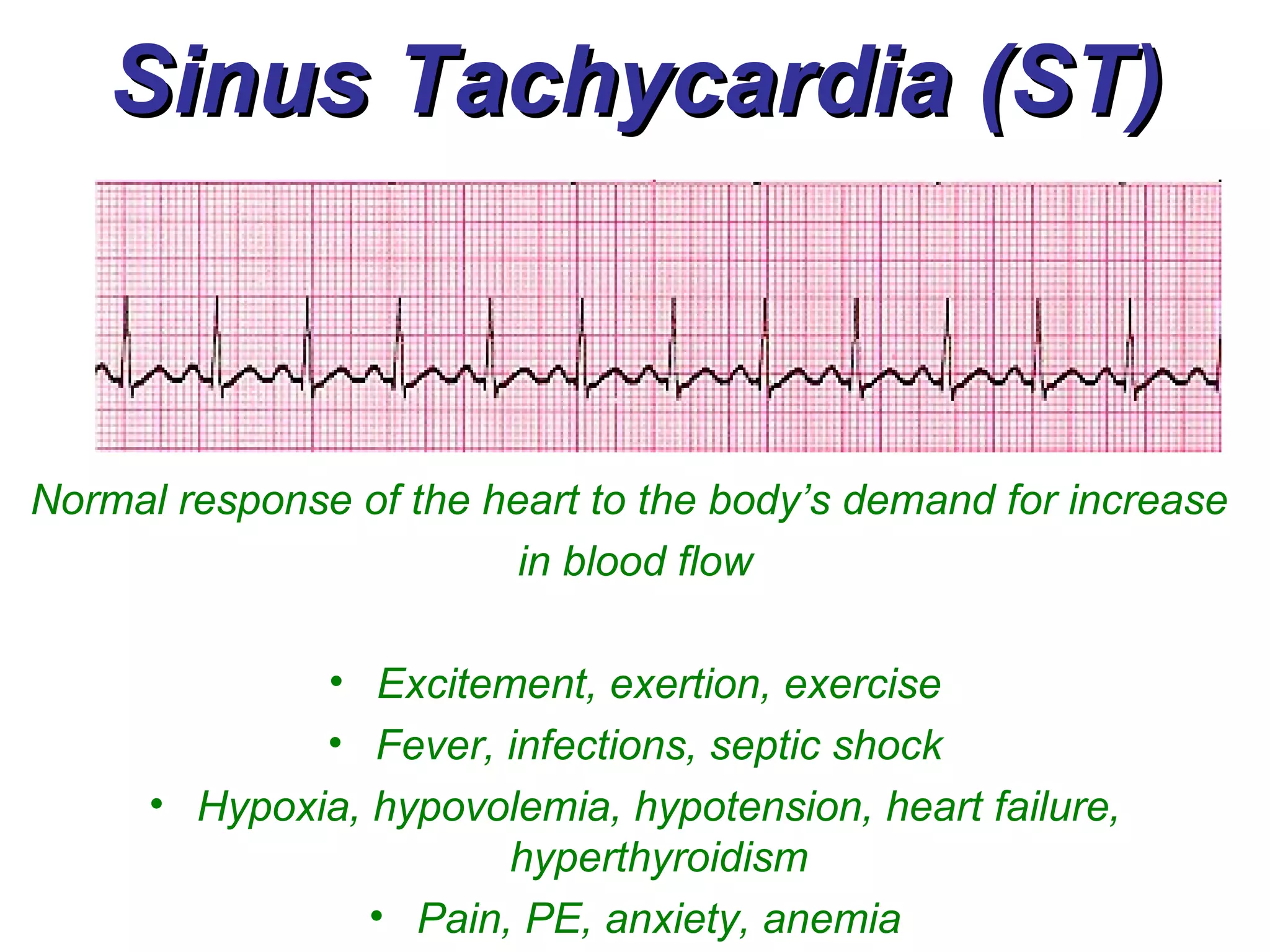 Sinus Tachycardia (ST) Normal response of the heart to the body’s demand for increase  in blood flow Excitement, exertion, exercise Fever, infections, septic shock Hypoxia, hypovolemia, hypotension, heart failure, hyperthyroidism Pain, PE, anxiety, anemia 