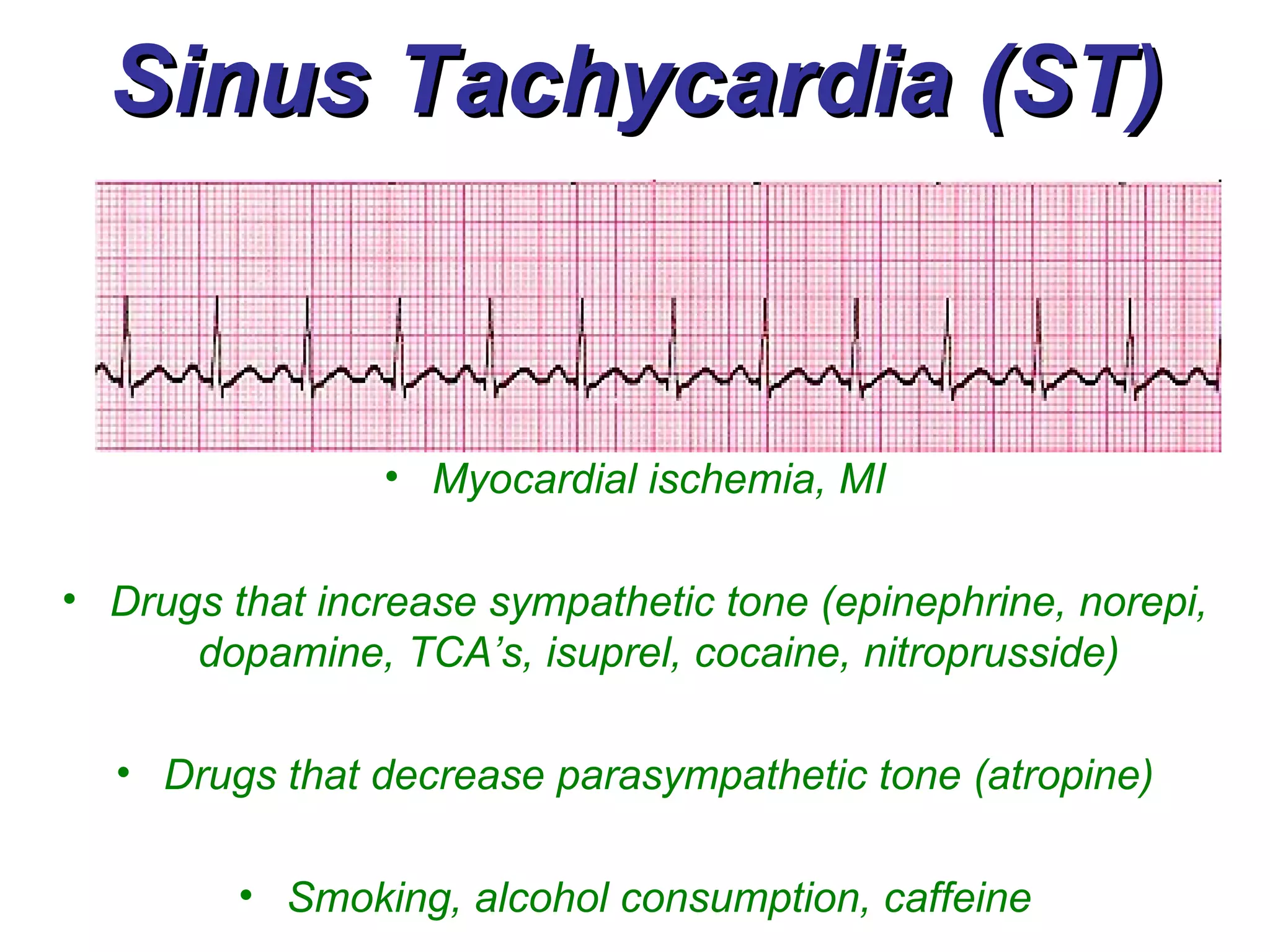 Sinus Tachycardia (ST) Myocardial ischemia, MI Drugs that increase sympathetic tone (epinephrine, norepi, dopamine, TCA’s, isuprel, cocaine, nitroprusside) Drugs that decrease parasympathetic tone (atropine) Smoking, alcohol consumption, caffeine 