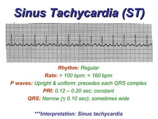 Sinus Rhythms - BMH/Tele | PPT