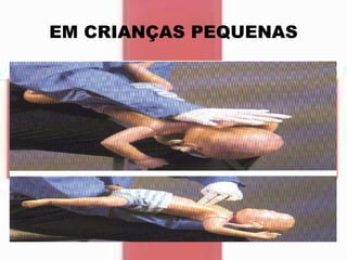 EM CRIANÇAS PEQUENAS
 