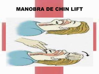 MANOBRA DE CHIN LIFT
 
