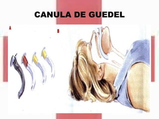 CANULA DE GUEDEL
 
