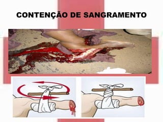 CONTENÇÃO DE SANGRAMENTO
 