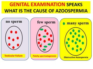 GENITAL EXAMINATION SPEAKS
WHAT IS THE CAUSE OF AZOOSPERMIA
no sperm many spermfew sperm
Testicular Failure
Obstructive Azoospermia
Patchy spermatogenesis
 