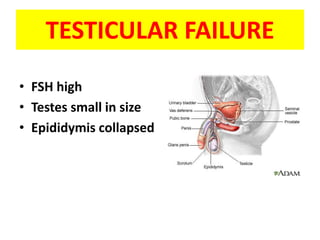 TESTICULAR FAILURE
• FSH high
• Testes small in size
• Epididymis collapsed
 