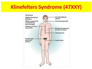 Klinefelters Syndrome (47XXY)
 
