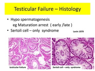Testicular Failure – Histology
• Hypo spermatogenesis
eg Maturation arrest ( early /late )
• Sertoli cell – only syndrome
testicular Failure Sertoli cell – only syndrome
Levin 1979
 