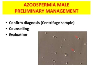 AZOOSPERMIA MALE
PRELIMINARY MANAGEMENT
• Confirm diagnosis (Centrifuge sample)
• Counselling
• Evaluation
 