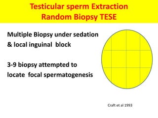 Testicular sperm Extraction
Random Biopsy TESE
Multiple Biopsy under sedation
& local inguinal block
3-9 biopsy attempted to
locate focal spermatogenesis
Craft et al 1993
 