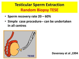 Testicular Sperm Extraction
Random Biopsy TESE
• Sperm recovery rate 20 – 60%
• Simple case procedure-- can be undertaken
in all centres
Deveroey et al ,1994
 